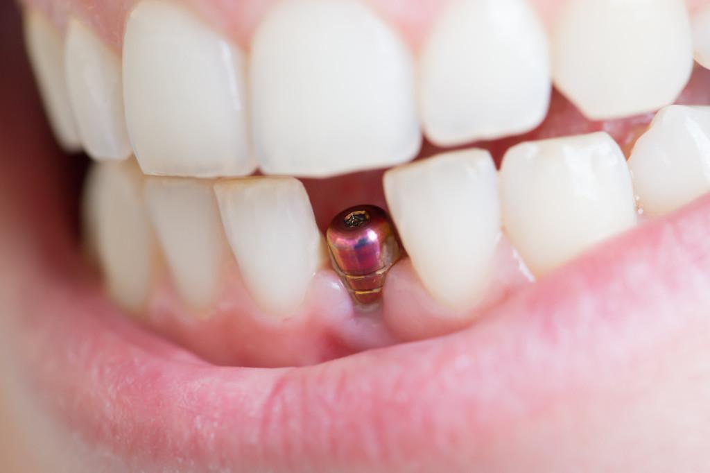 Implanty zębowe Stalowa Wola